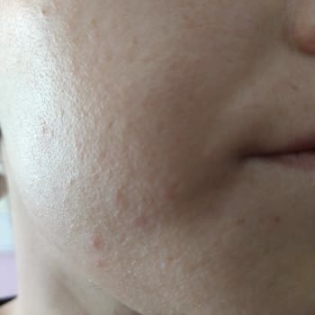 Oruçoğlu Thermal Resort Cilt Bakımı Sonrası Sorun Yaşadım