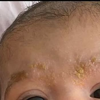 Sebamed Bebek Şampuanı Yaralar Yaptı