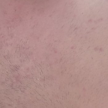 Gensenta Prednol İlaç Yan Etkisi