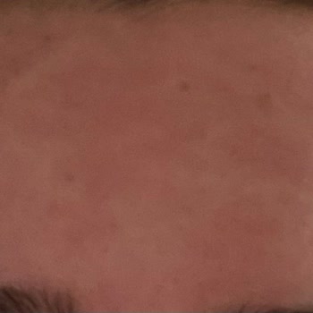 Missha Yüz Maskesi Yüzümü Kızarttı