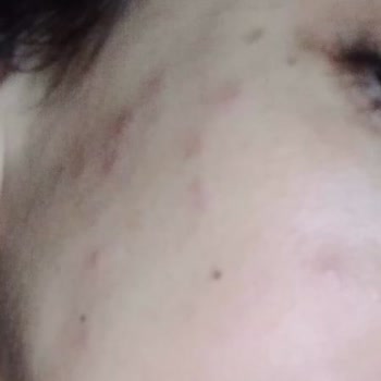 Rise Shine Madarise Krem Sivilce