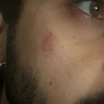 Remove Ağda Cildi Tahriş Etti!