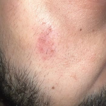 Remove Ağda Cildi Tahriş Etti!