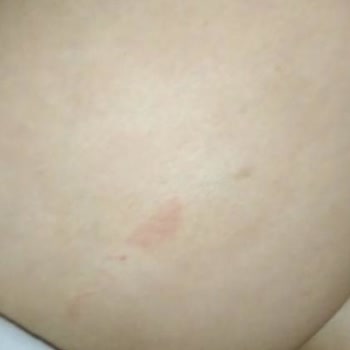 Esteclinice Güzellik Hizmetleri (Bağcılar) Lazer Yanığı Dava Sebebidir