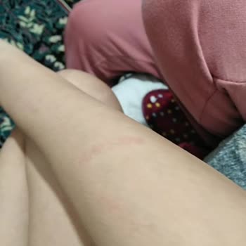 Esteclinice Güzellik Hizmetleri (Bağcılar) Lazer Yanığı Dava Sebebidir