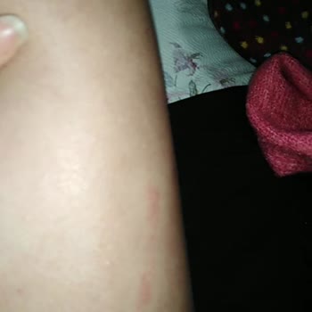 Esteclinice Güzellik Hizmetleri (Bağcılar) Lazer Yanığı Dava Sebebidir