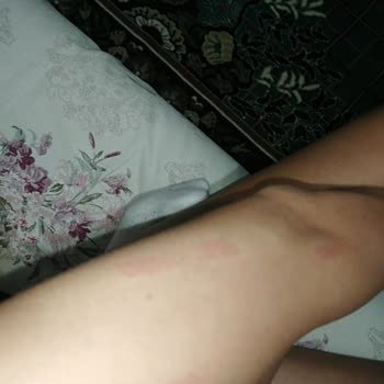 Esteclinice Güzellik Hizmetleri (Bağcılar) Lazer Yanığı Dava Sebebidir