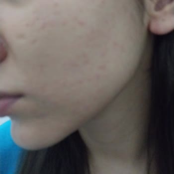 Bioderma Kızarıklık Ve Yanma