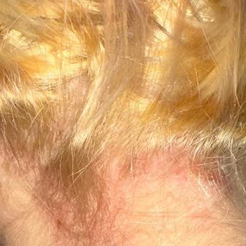 Palette 10-1 Deri Yanığı Ve Yaralar