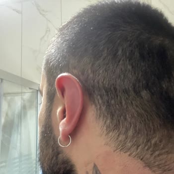 Medica Derma Lazer Epilasyon Hizmeti