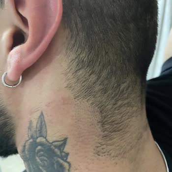 Medica Derma Lazer Epilasyon Hizmeti