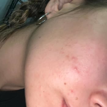 Loreal Paris Nem Terapisi Suyu Yüzümü Yaktı