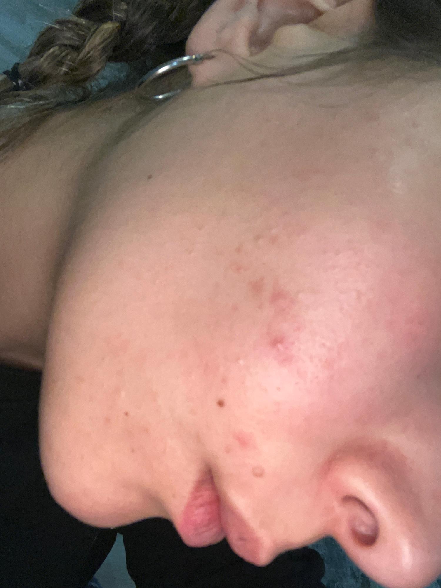 Loreal Paris Moisture Therapy Burned My Face Xolvie