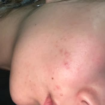 Loreal Paris Moisture Therapy Burned My Face