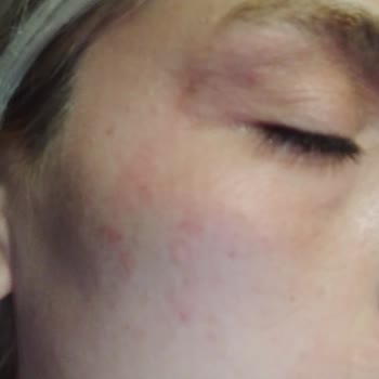 Cerave Krem Cildim Çok Kötü Durumda...