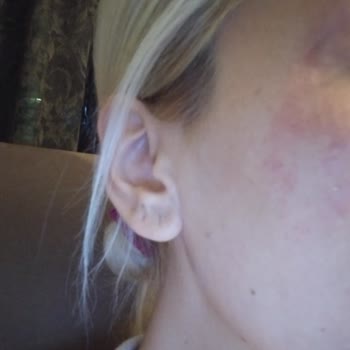 Cerave Krem Cildim Çok Kötü Durumda...