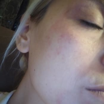 Cerave Krem Cildim Çok Kötü Durumda...