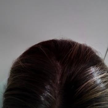 Üçons Kuaför Başarısız Saç Boyama İşlemi