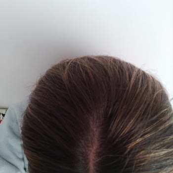 Üçons Kuaför Başarısız Saç Boyama İşlemi