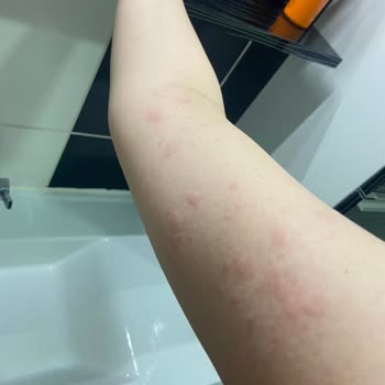 La Roche Posay Effaclar Kullandım Ve Hastanelik Oldum