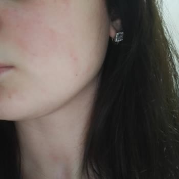 Rise & Shine Maderis Kremi Sabunu Kullanımı Sonrası Ciltte Kabarcıklar Oluştu