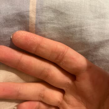 Vanish Kosla Elimi Yaktı Sızlıyor