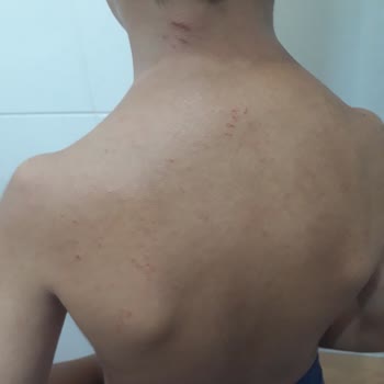 Bepanthol Krem Kaşıntı Yaptı