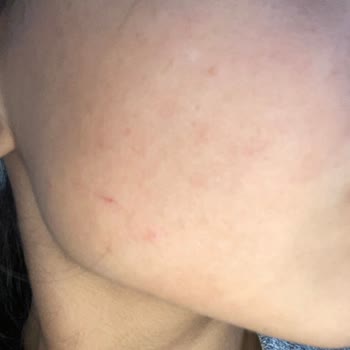 Rise & Shine Sabun Sivilce Yaptı