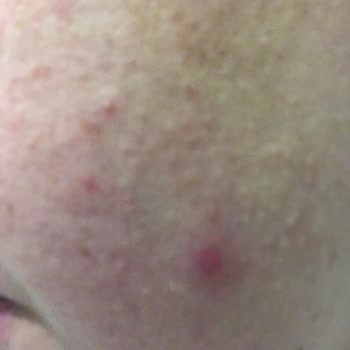 Solante Aknetrend Tedavimi Çöp Eden Güneş Kremi