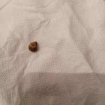 Yurt Konserve Yurt Haşlanmış Fasulye Konservesinin İçinden Taş Çıktı.