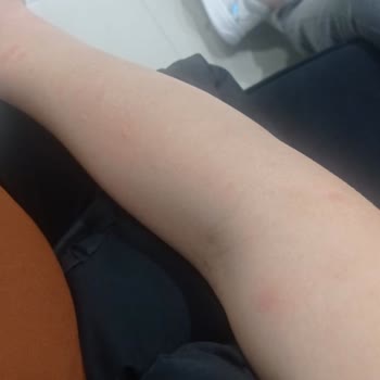 Esteline Güzellik Merkezi Estelina Güzellik Yanık