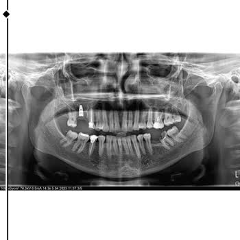 Medipol Sağlık Grubu Esenler Diş Hastanesinde 05.04.23'de Civil'i Diş Tedavisi İçin