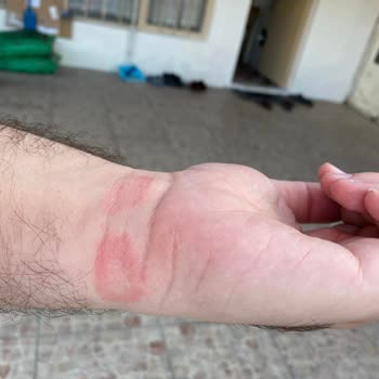 Apple Watch Yara Yapıyor