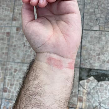 Apple Watch Yara Yapıyor