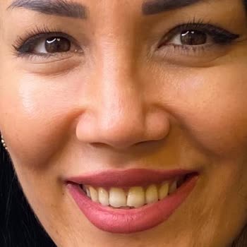 Op. Dr. Hüseyin Burak Bayraktar Burnumu Yamuk Yaptı