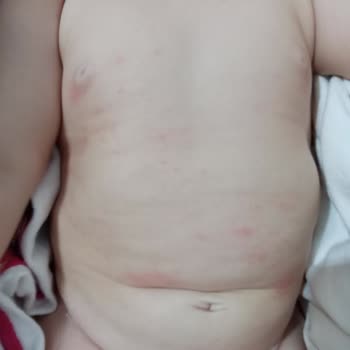 Sleepy Bebek Bezi Bebeğimin Cildini Mahvetti