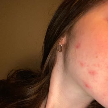 Neutrogena Sivilce Karşıtı Yüz Yıkama Jeli Cildimi Mahvetti