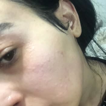 The Purest Solutions Cildimi Mahvetti Ve Yaktı