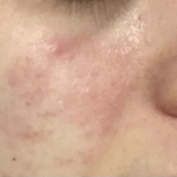 Rise & Shine Pişmanlıktır! Yüzüm Mahvoldu