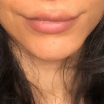 Linemed Beauty Linemed Yüzümü Mahvetti