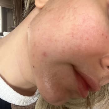 Pervin Dinçer Beauty Nisantasi Baby Face Uygulaması