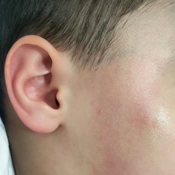 Johnson Baby Şampuan Alerji Yapıyor