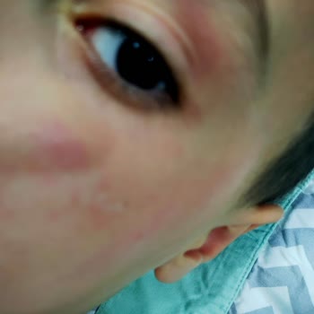 Johnson Baby Şampuan Alerji Yapıyor