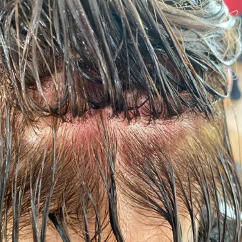 Deniz Kuaför (Fethiye) Başımın Yanması Ve Mağduriyetin Giderilmemesi