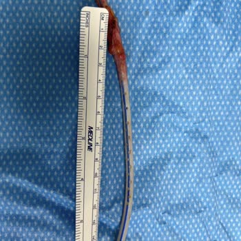 Doç. Dr. Burhan Özalp Karnımda 19 Cm Dren Unuttu