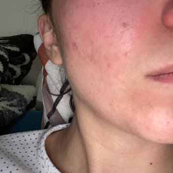 Ziaja Tonik Ve Gündüz Kremi Yan Etki Yaptı