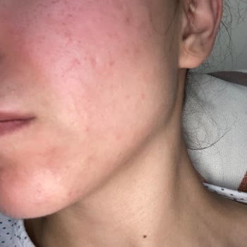 Ziaja Tonik Ve Gündüz Kremi Yan Etki Yaptı