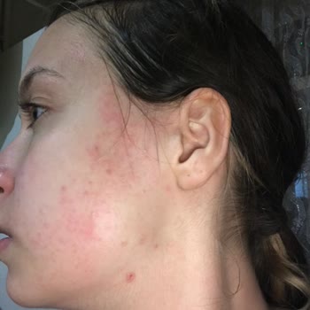 Gratis Claderm Kil Maskesi Alerji Yapıyor