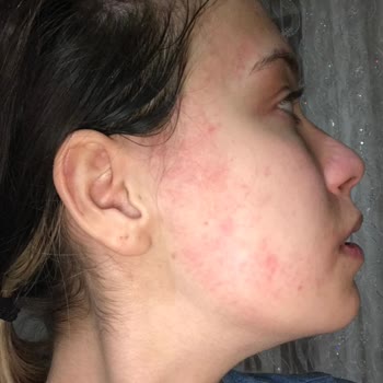 Gratis Claderm Kil Maskesi Alerji Yapıyor