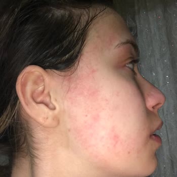 Gratis Claderm Kil Maskesi Alerji Yapıyor